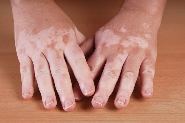 vitiligo voi parantaa