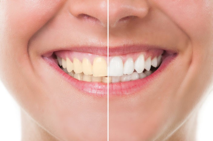 Hampaiden valkaisemisen valkaisuun liittyvät sivuvaikutukset