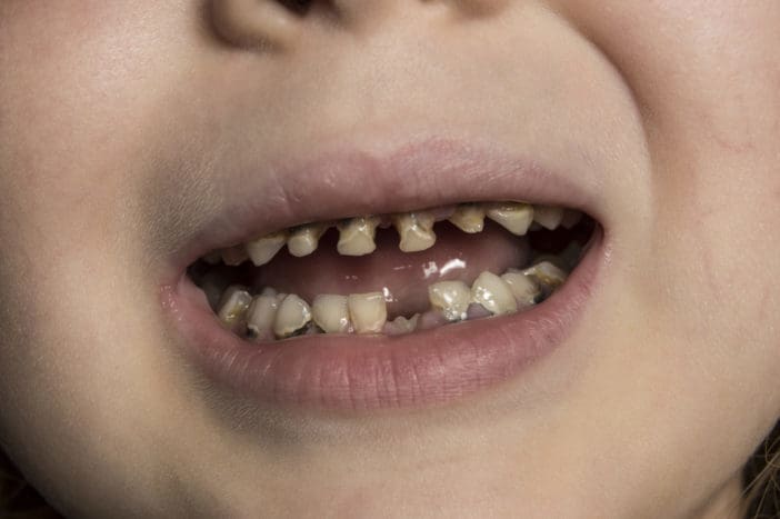 vauvapullon hampaiden hajoaminen lasten hampaiden hajoamiselle