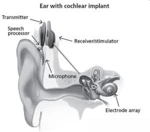 cochlear implanttilaite