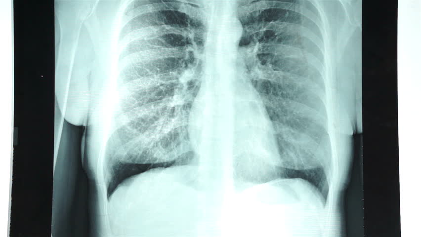 rintakehän röntgen