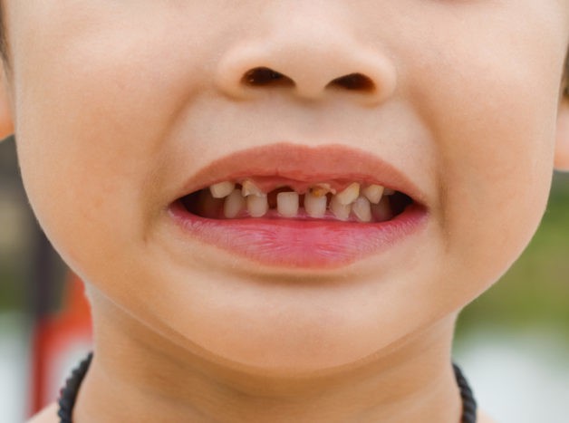 lasten hampaiden vahingoittuminen