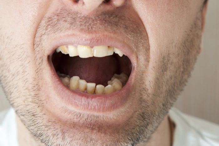 miten estää hammaskiveä