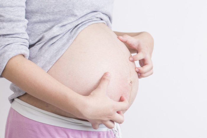 Pruriittinen follikuliitti on syynä kutiaan ihoon raskauden aikana